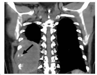 第四軍醫大學精彩分享個性化醫療3D打印的實戰案例與研究成果
